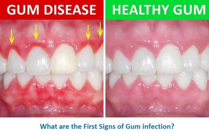 Gum disease treatment remedies natural